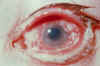 conjunctivitis-GC.jpg (360755 bytes)