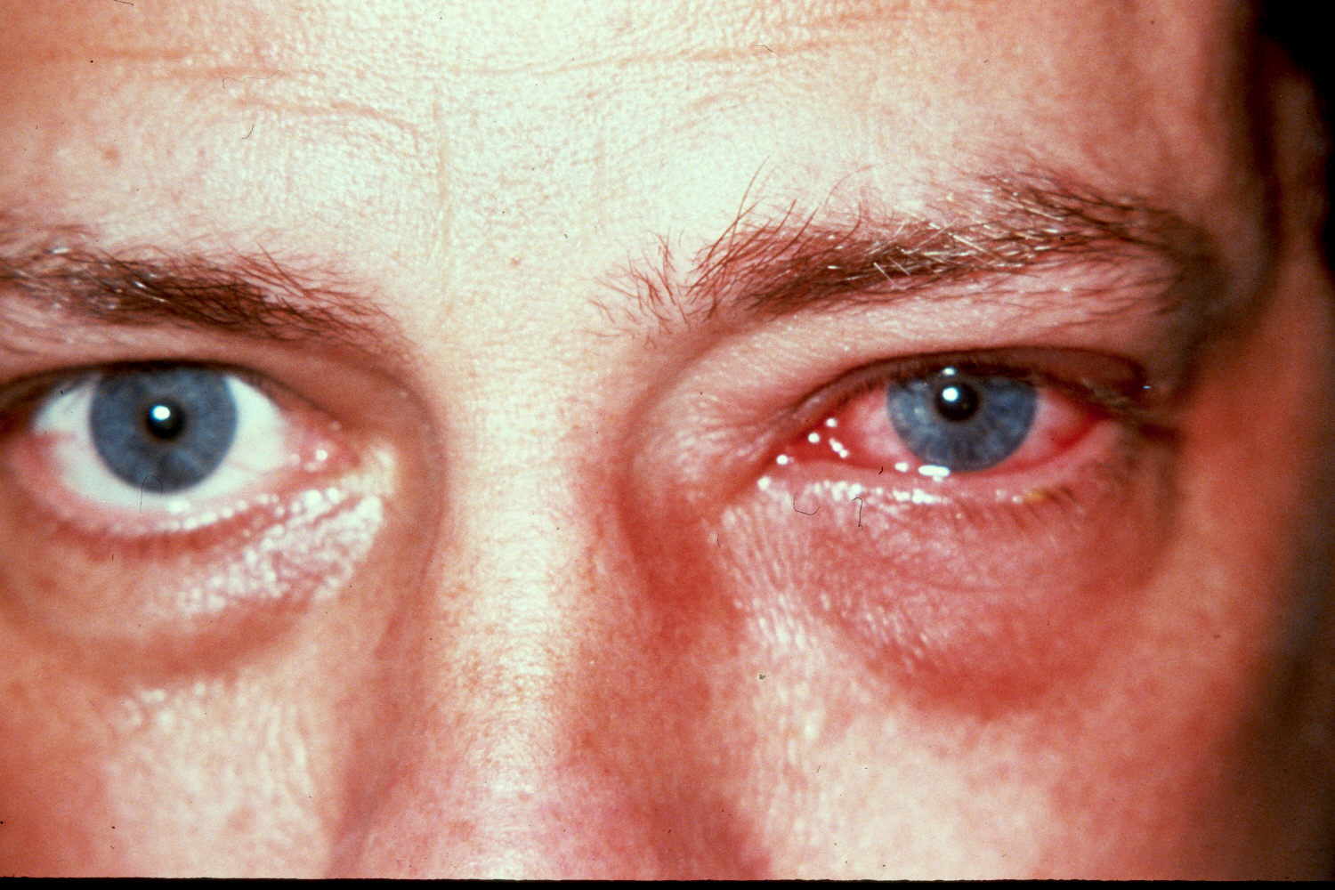 Conjunctivitis Images - Photos - Pictures - CrystalGraphics