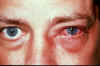 conjunctivitis-viral.jpg (334166 bytes)