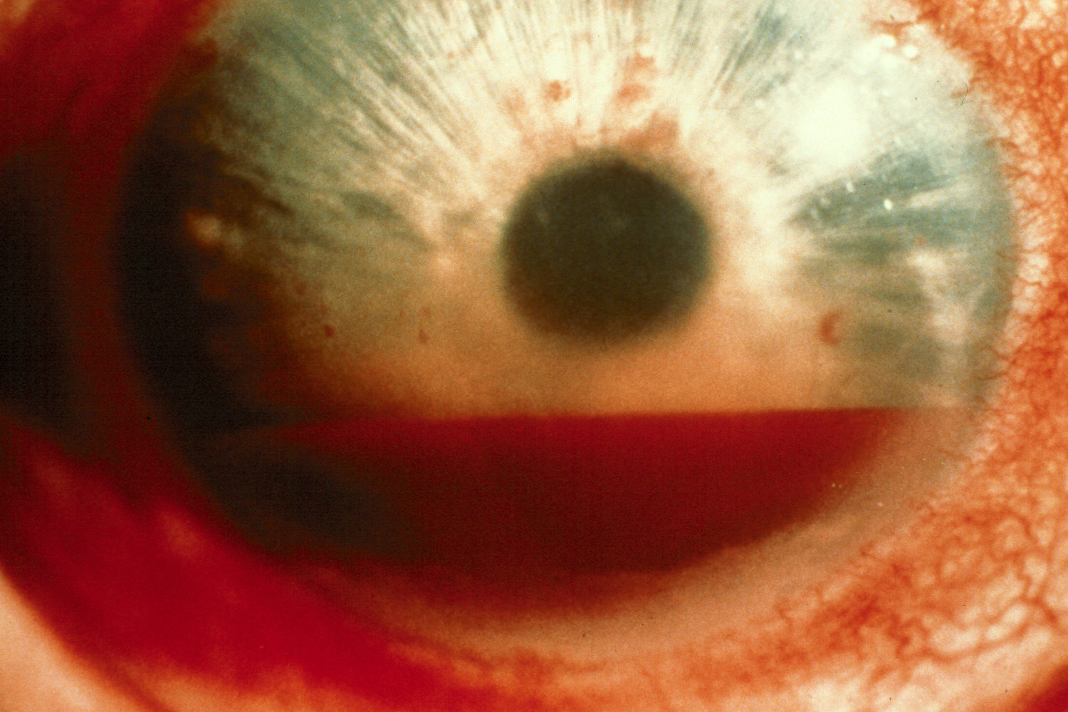 Corneal Abrasion in Adults: Condition, Treatments, and ...